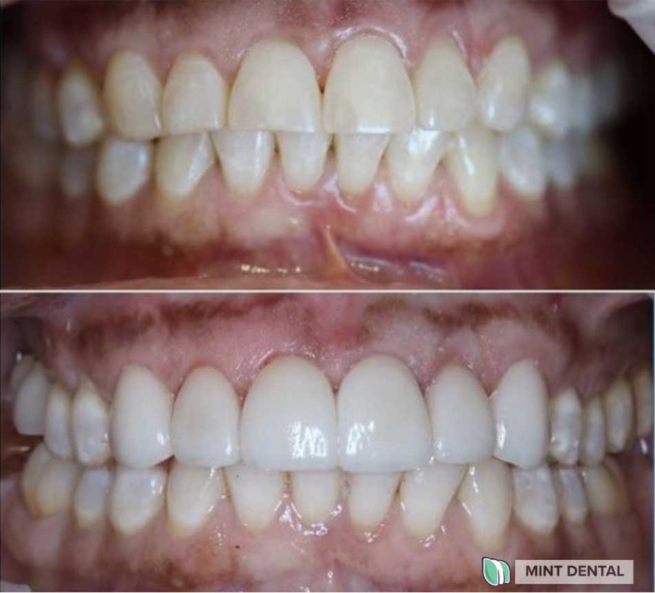 Cosmetic Dentistry 4 Porcelain Veneers | Cosmetic Dentistry Veneers