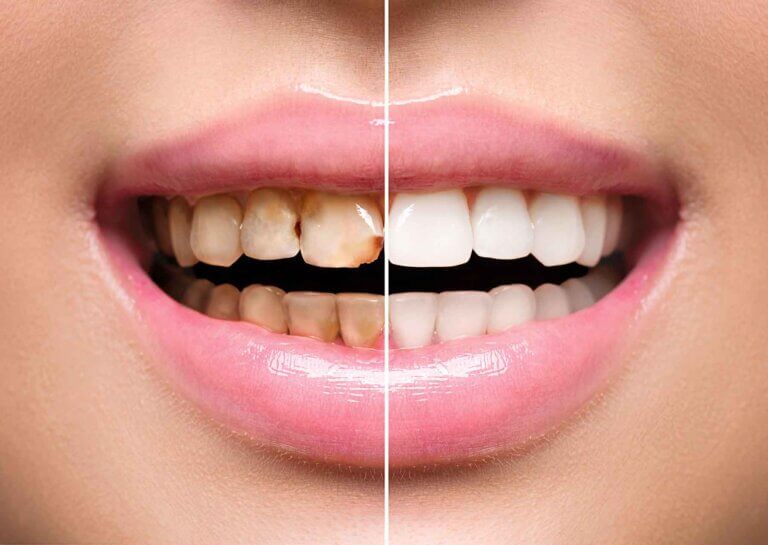 professional teeth whitening