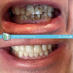 Same Day Crowns: Revolutionizing Dental Care 1 same day crown smile transformation